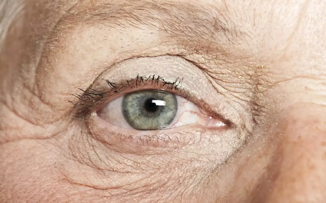 Fact or Fiction? 7 Common Misconceptions About Pink Eye