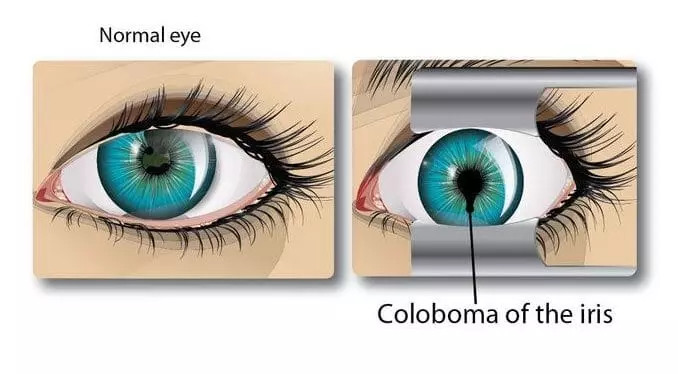 Coloboma of the iris Information