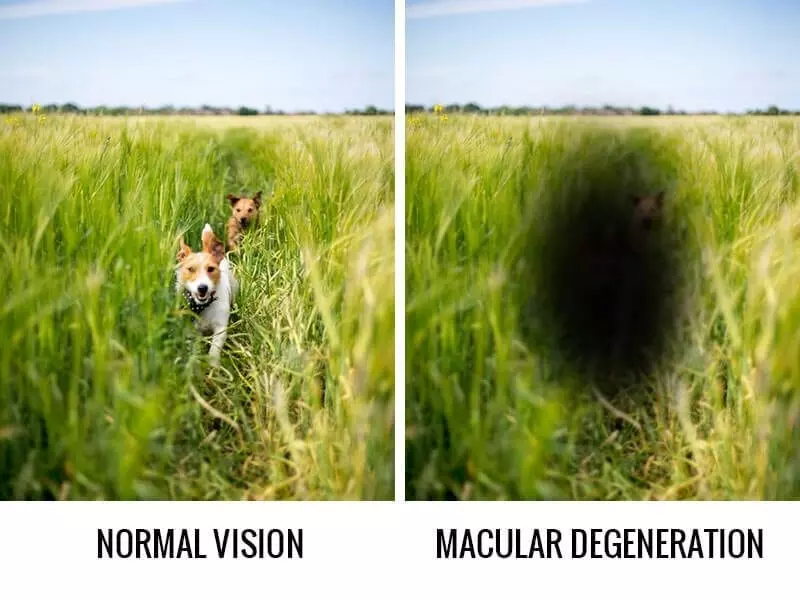 What You Need To Know About Macular Degeneration